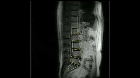 Automated vertebral tracking algorithms - HASTE ACTIVE
