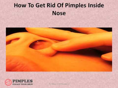 How To Get Rid Of Pimples Inside Nose