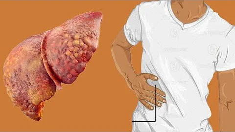Cirrhosis Of Liver: Life Expectancy By Stage - DayDayNews