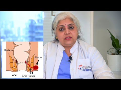 Video: Cum să vindeci o fistulă (cu imagini)