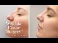 Nose Job Before And After Transformation - Rhinoplasty Surgical Footage