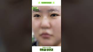 눈이 확! 커지고 싶으신 분들께 추천! #민트실상안검전후