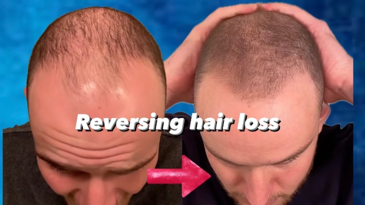 FINASTERIDE / MINOXIDIL IS IT SAFE? Reversing hair loss EP 3: pt 2