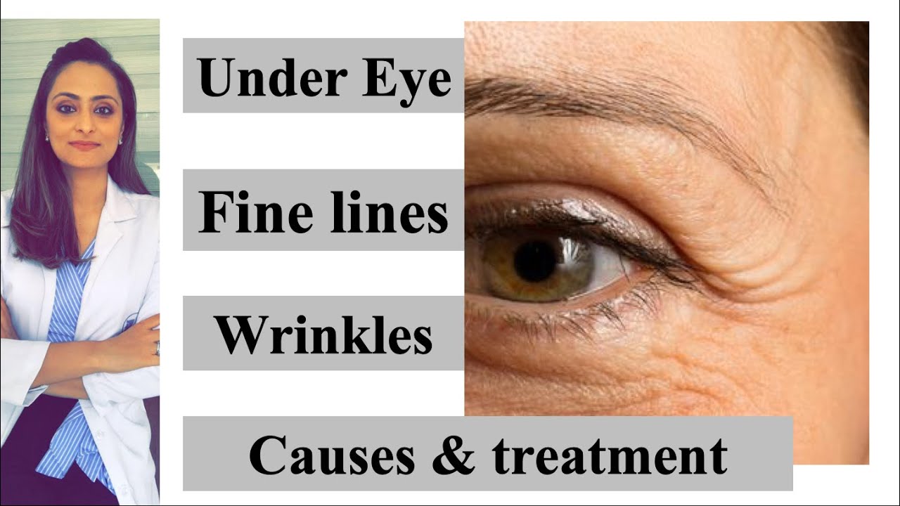 Fine lines, wrinkles, under eye, causes & treatment