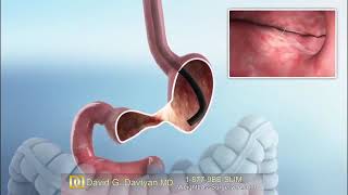 Gastric Sleeve Revision Surgery Animation