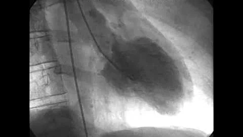 Procedural Coronary Angiography of Coronary Artery Thrombus Aspiration Followed by Bolus Intracorona - DayDayNews