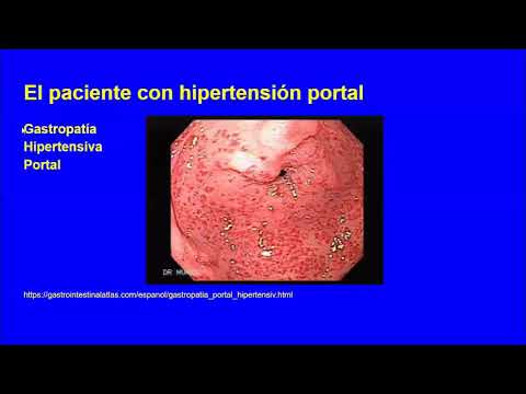 15 6 Hipertensión portal