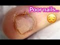 Amazing Transformation | Best Shape for Short Bitten Nails