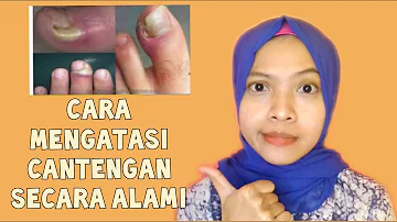 CARA MENGATASI KUKU CANTENGAN SECARA ALAMI | OBAT HERBAL CANTENGAN JEMPOL KAKI