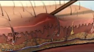 inflammatory reaction in 3D animation.