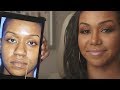 Ethnic Rhinoplasty Before and After Transformation Patient Story