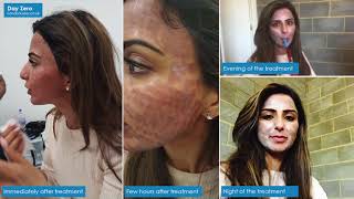 CO2 Laser Resurfacing treatment at London Laser Clinic