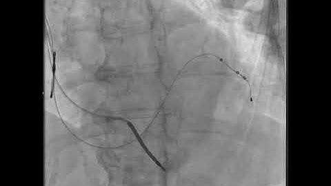 Video 10 Hook Vein selector for acutly angulated target vein off great cardiac vein with permission