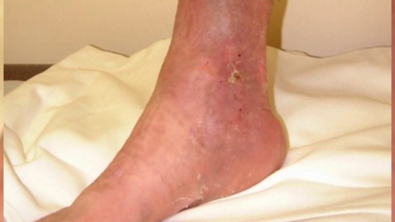 symptoms of deep vein thrombosis in leg symptoms of deep vein thrombosis in leg