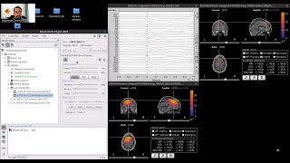 EEG source imaging of epilepsy recordings using Brainstorm