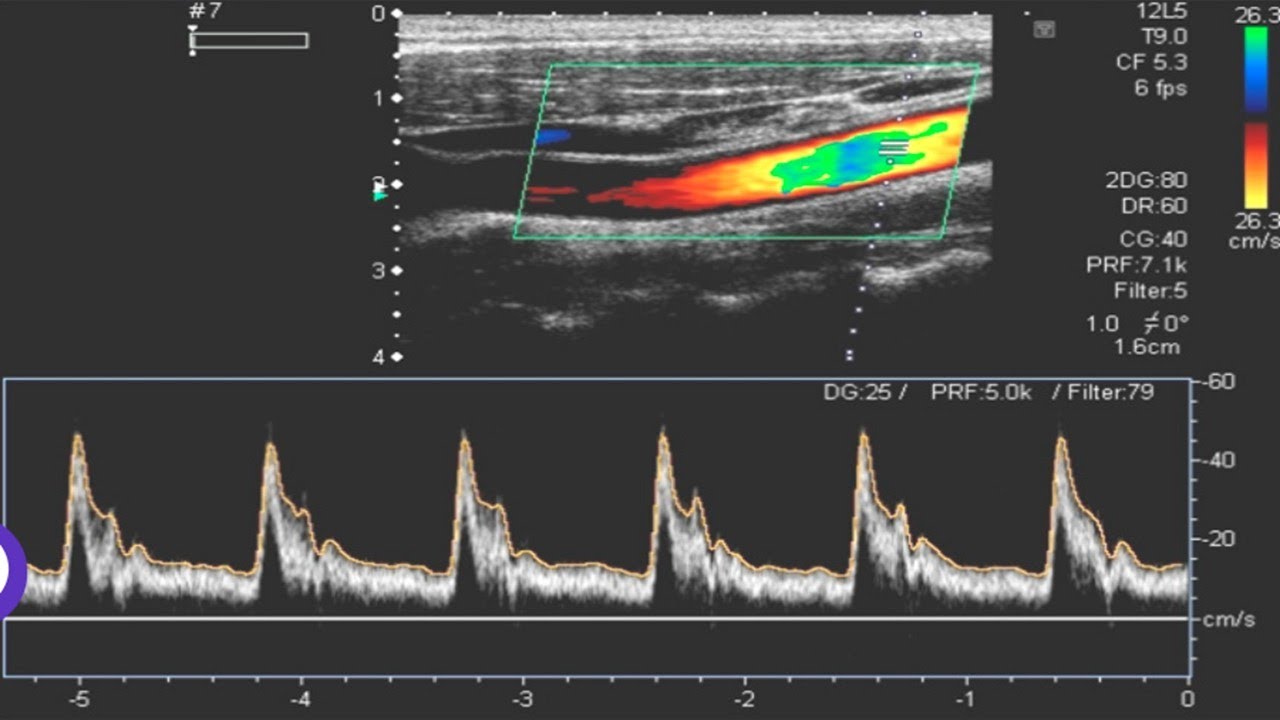 Power Doppler Ultrasound – High-Sensitivity Blood Flow Imaging and ...