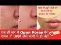 Get rid of open poresओपन पोर्स जड़ से खत्म करें100%Result || Open Pores Home Remedy in Hindi