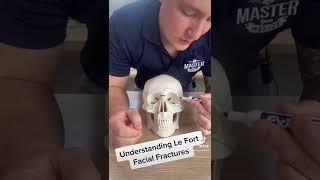 Understanding Le Fort Facial Fractures