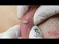 Satisfying Relaxing with Sac Dep Spa Video (#080) #SacDepSpa - Super Big Acne