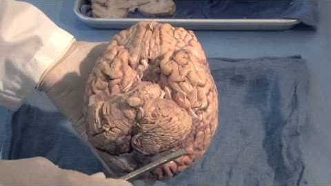 Orientation - The Planes of the Brain: Neuroanatomy Video Lab - Brain Dissections