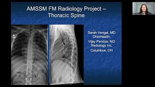 Thoracic Spine | MSK Radiology: X-Ray Educational Modules for Primary Care Residents