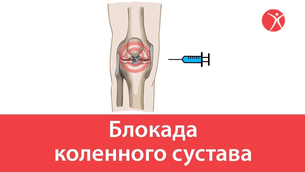 Блокада коленного сустава