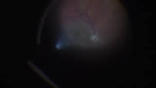 ?جراحة شبكية العين