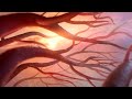 Sickle cell disease  moa animation