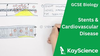 GCSE Biology - Using Stents To Treat Cardiovascular Disease