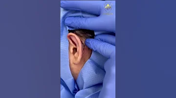 OTOPLASTY By Dr Maen Al Khateeb عملية الأذن الوطواطية أو البارزة مع د معن الخطيب Shorts 