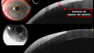 Multi CEO - Neoplasia escamosa de la superficie