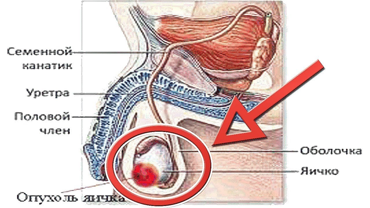Болит в правом яичке у мужчин. Новообразование на яичке. Семенной канатик у мужчин.