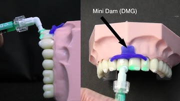 ICON Treatment Tutorial