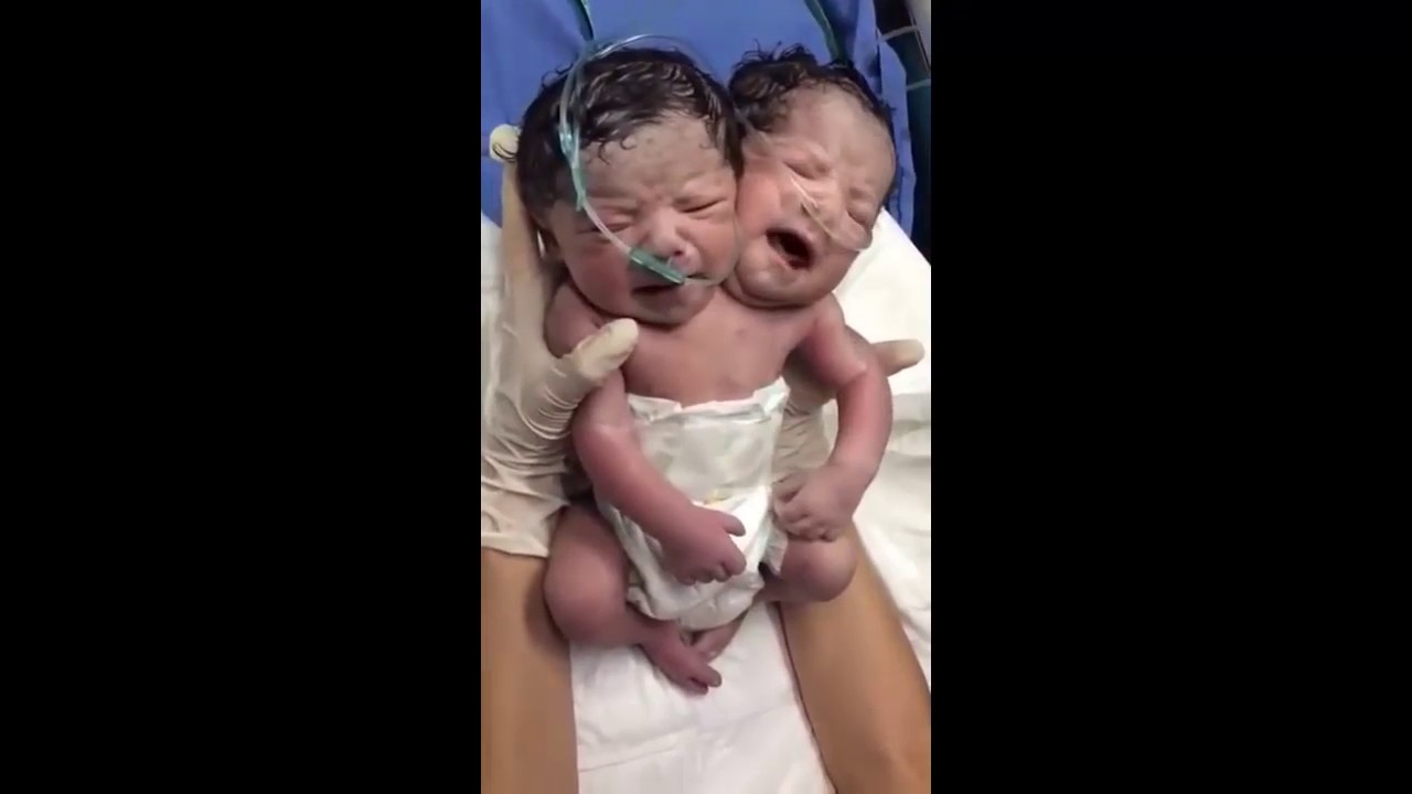 nace bebe de 2 cabezas en mexico YouTube