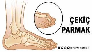 Çekiç Parmak Nedir, Nasıl Tedavi Edilir? Prof. Dr. Yakup Yildirim