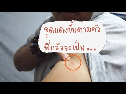 จุดแดงขึ้นตามตัว พี่กลัวจะเป็น...