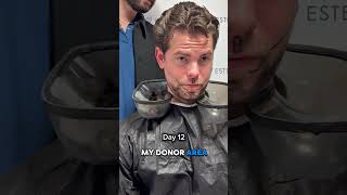 No-Shave Beard Transplant 6 Months Result