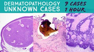 Random Dermpath Cases (tick mouthparts, Masson, Pinkus, Fournier gangrene, etc)dermatology pathology