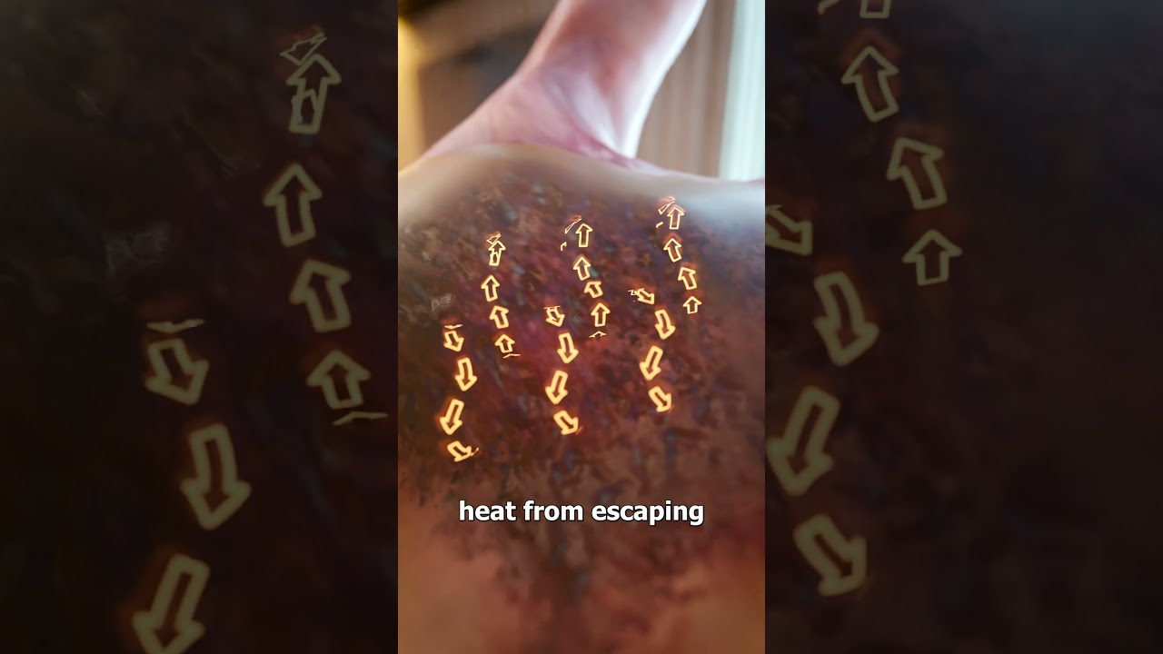 Common Burn Treatment Myths 