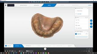 Digital Altered Cast Denture Technique