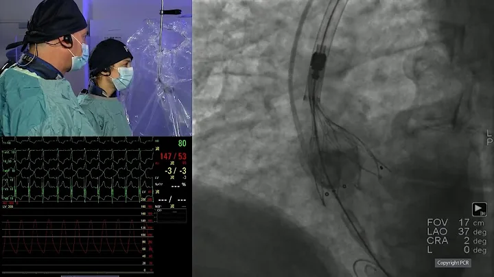 The index valve matters: optimal index TAVI for a lifetime of possibilities - PCR London Valves 2025