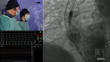 The index valve matters: optimal index TAVI for a lifetime of possibilities - PCR London Valves 2025