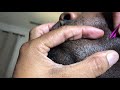 Ingrown Hairs | Picking My Husbands Face!