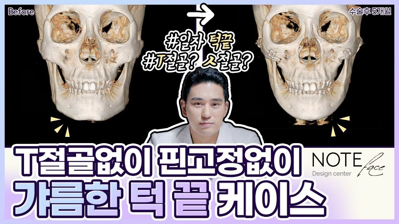 [유.케.리] 📍 CT로 보는 케이스 리뷰 l 광대축소 + 핀리스 브이라인 l