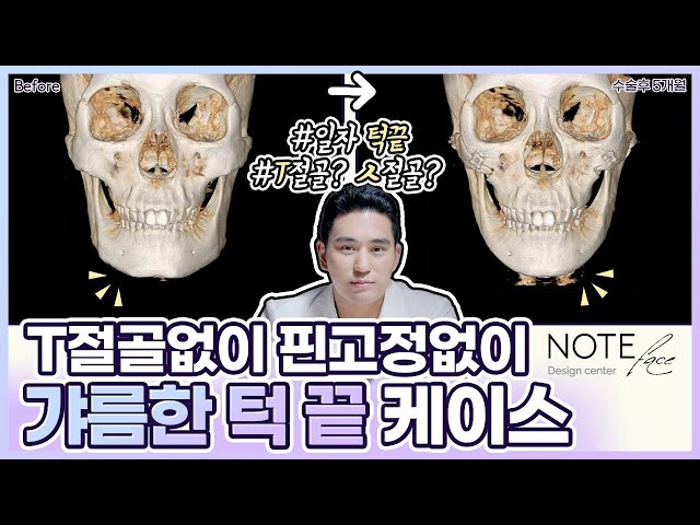 [유.케.리] 📍 CT로 보는 케이스 리뷰 l 광대축소 + 핀리스 브이라인 l