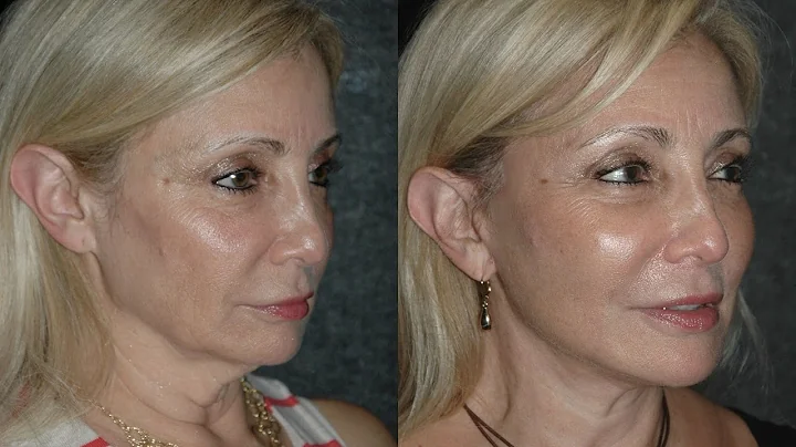 Local Anesthesia Neck Lift Before and After #necklift