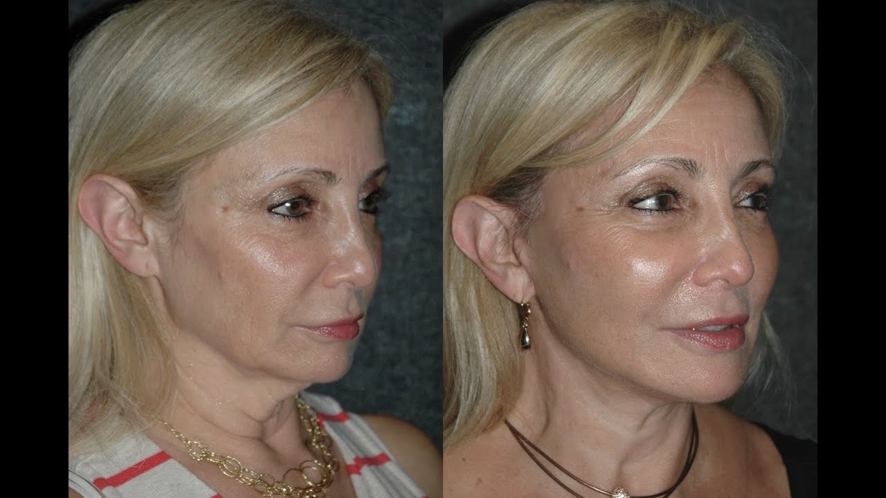 Local Anesthesia Neck Lift Before and After 59 Year Old with Turkey Neck and Jowls YouTube