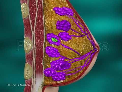 Video: In situ kjønnscelle-neoplasi?