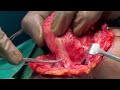 Branchial Cyst Excision