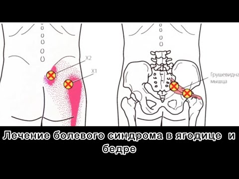 Миопрессура грушевидной и задней поверхности бедра. Ишиас. Боль в ноге #ишиас #ишалгия #боль